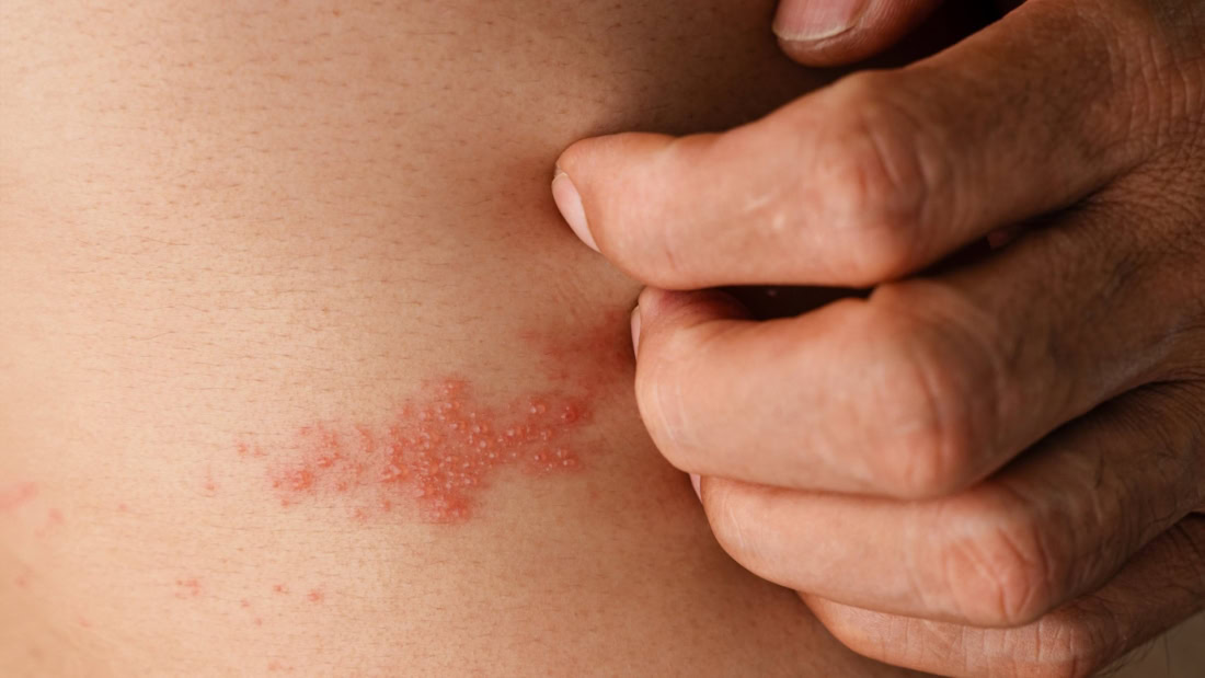 Visible rash and blisters due to shingles on back, medical condition.