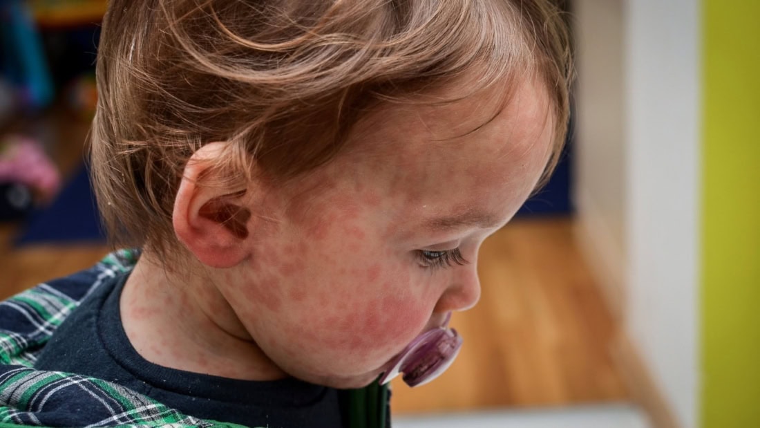 Skin rash and fever in a child with measles, health care and symptoms.
